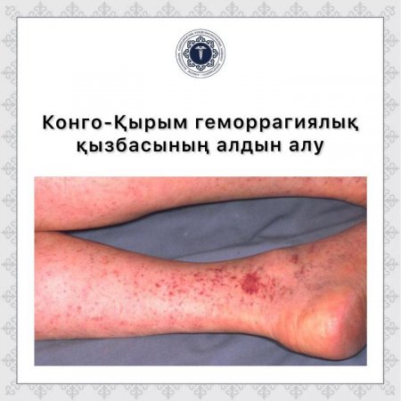 Конго-Қырым геморрагиялық қызбасының алдын алу шаралары